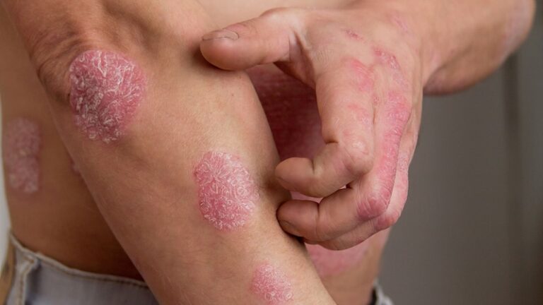 Psoriasi e mandibola