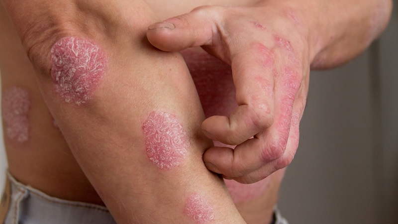 Psoriasi e mandibola