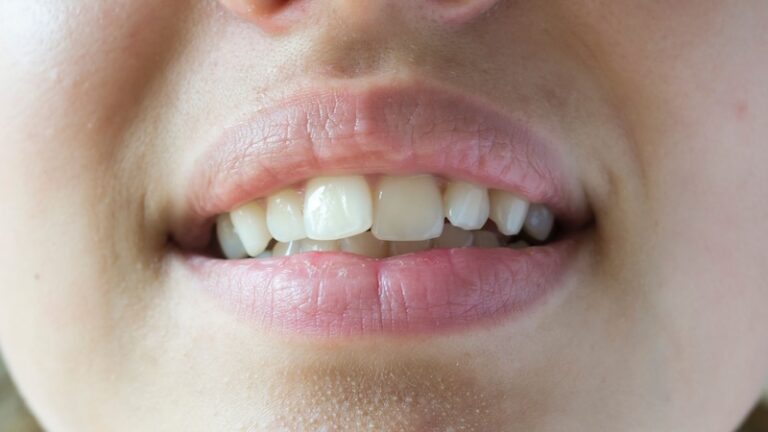 Malocclusione